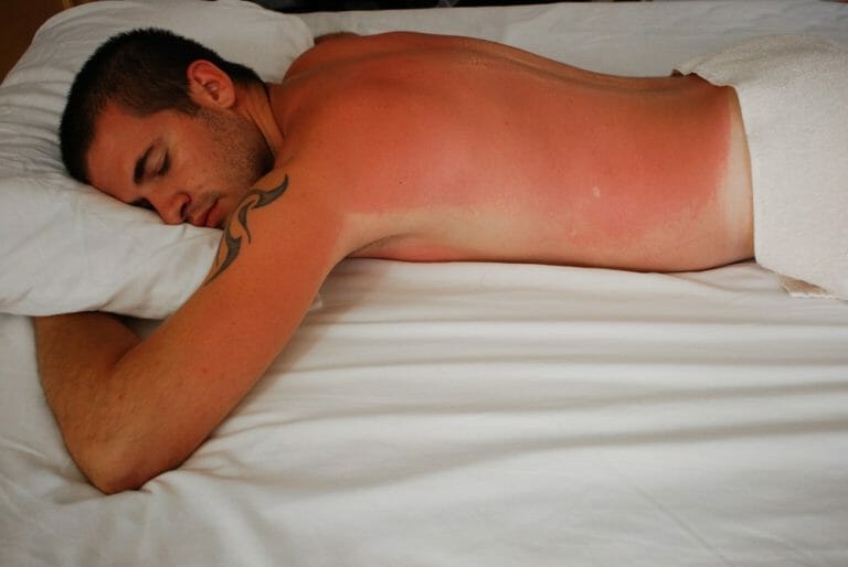 How To Sleep With Sunburn – A Guide